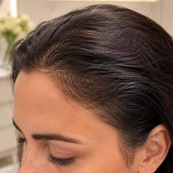 Hair-Transplant